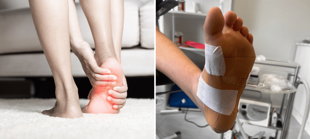 Images of the pain and treatment associated with plantar fasciitis