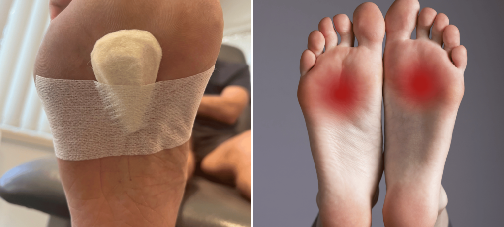 Images of the pain and treatment associated with pain in the ball of the foot