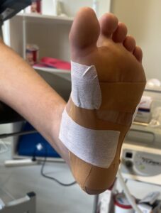 Strapping of foot for treatment of Flexor Hallucis Longus (FHL) tendinopathy