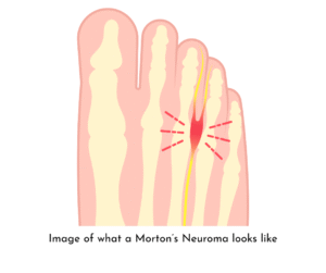 Morton's Neuroma image of what it looks like