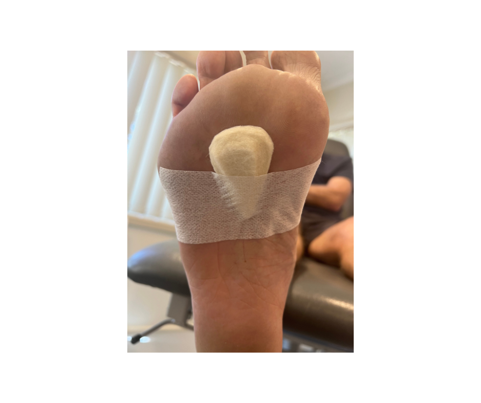 Morton'sNeuroma. Picture of pad used to help relieve Morton's Neuroma pain